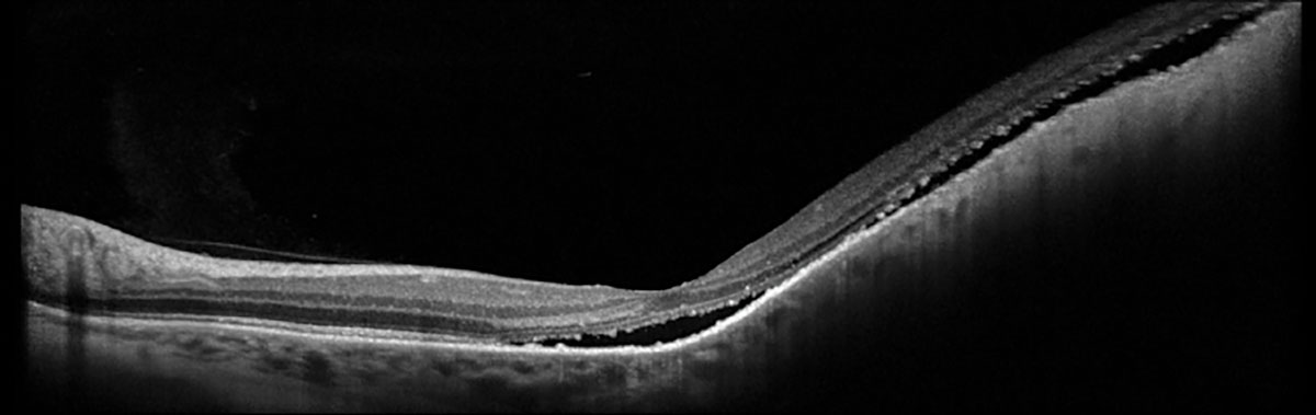 Fig. 2. Heidelberg OCT of left eye.