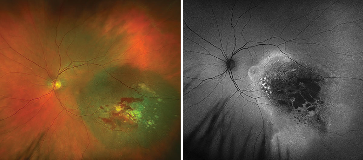 Fig. 4. Optos widefield fundus photography and autofluorescence of the left eye at one-month post-op.