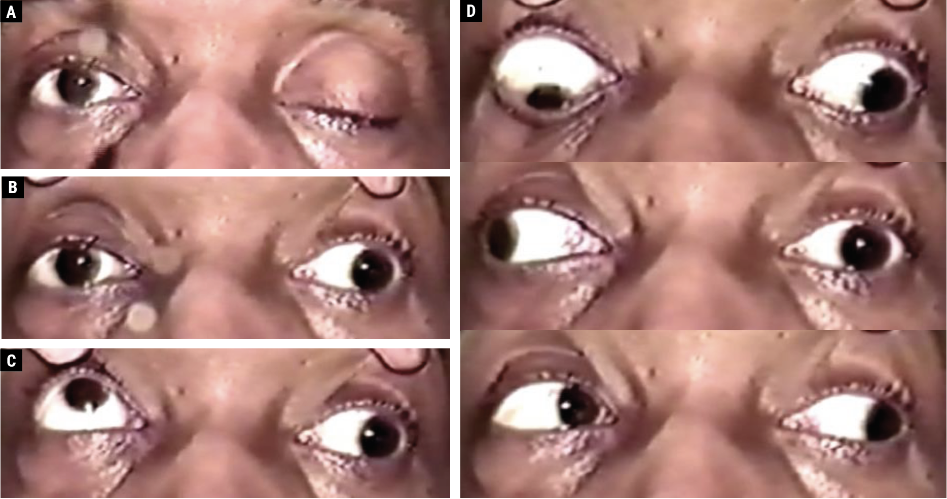 Fig. 1. A 48-year-old male with an aneurysmal left CN III palsy with complete upper eyelid ptosis (A). With manual eyelid elevation, the left eye is positioned out and slightly down; the left pupil is mid-dilated and reacts poorly to a light stimulus (B). On attempted upgaze, the right eye elevates fully, and there is a supraduction deficit involving the left eye (C). The righthand images (D) depict the following (top to bottom): on attempted downgaze, the right eye depresses fully, and there is an infraduction deficit involving the left eye; on attempted right gaze, the right eye abducts fully, while an adduction deficit involves the left eye; on attempted left gaze, there is complete adduction of the right eye and complete abduction of the left eye, which remains slightly depressed.