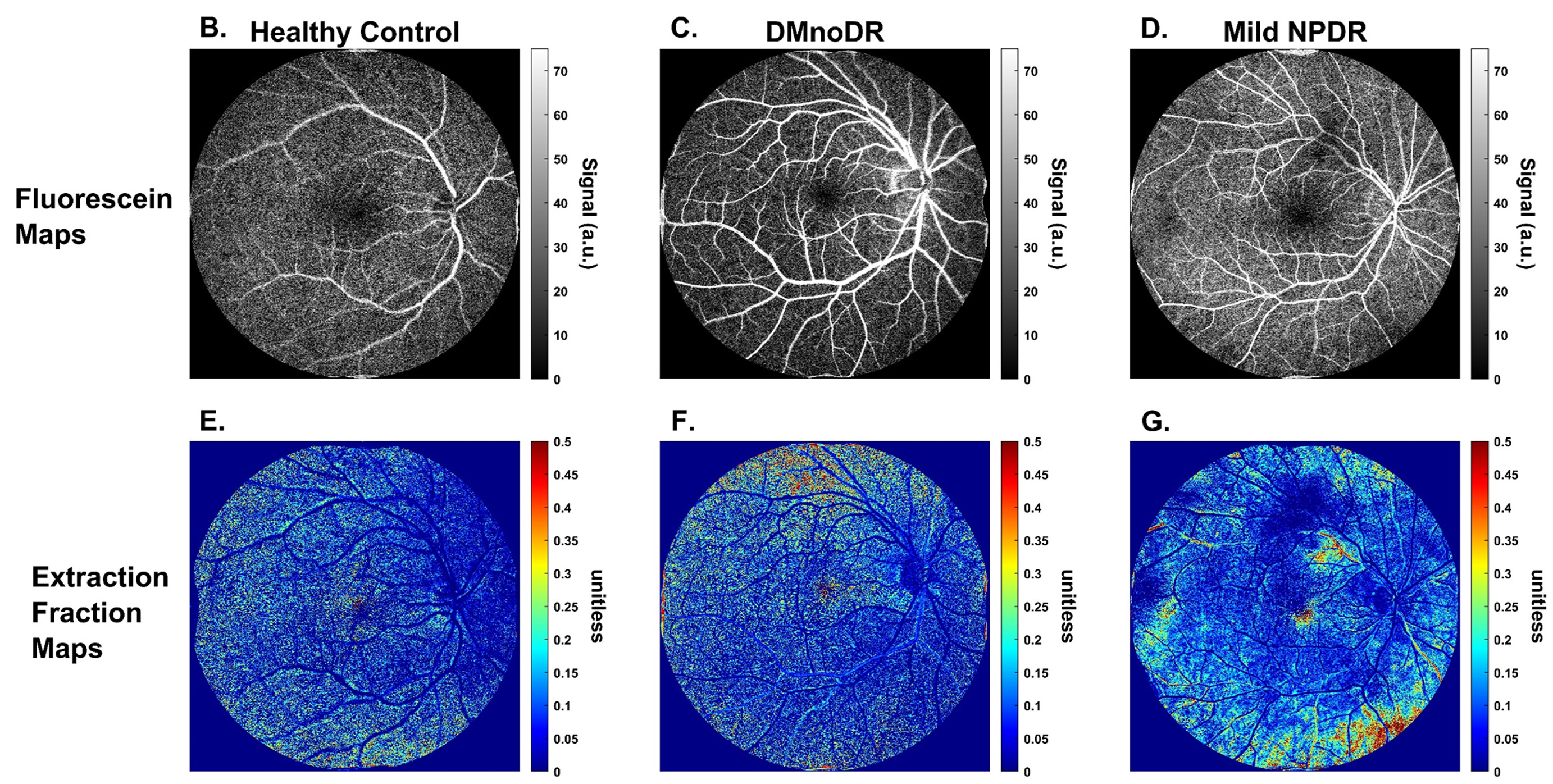 A routine retinal fluorescein videoangiography dataset could be used to quantify vascular permeability—a functional parameter of the vasculature that is hypothesized to be affected prior to the early structural changes detectable by OCT-A and AO- and adaptive optics scanning laser ophthalmoscopy—in human retinas. These images from the study show examples of pixel-by-pixel fluorescein maps for (A) a control subject, (B) a diabetes subject with no DR, and (C) an individual with mild NPDR with corresponding extraction fraction maps (D, E, F) for each.