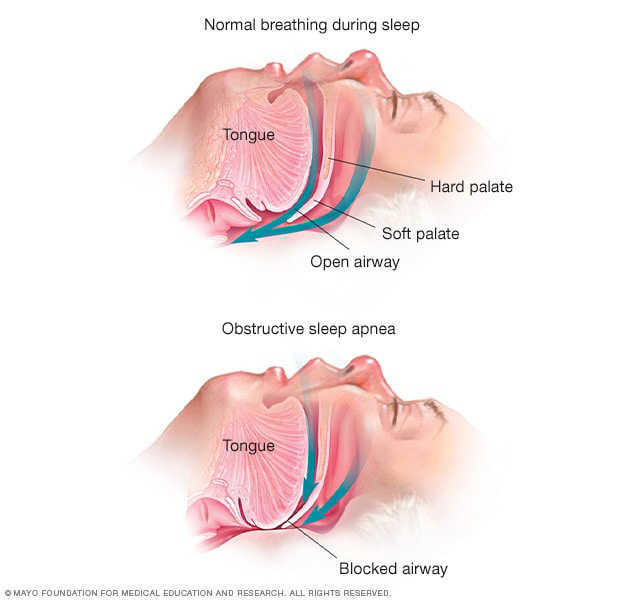 High blood pressure increased ciliary artery pressure in the eye, elevating ultrafiltration and the production of aqueous humor, which has been thought as the cause for increased IOP, thus hypertension being important to check for.