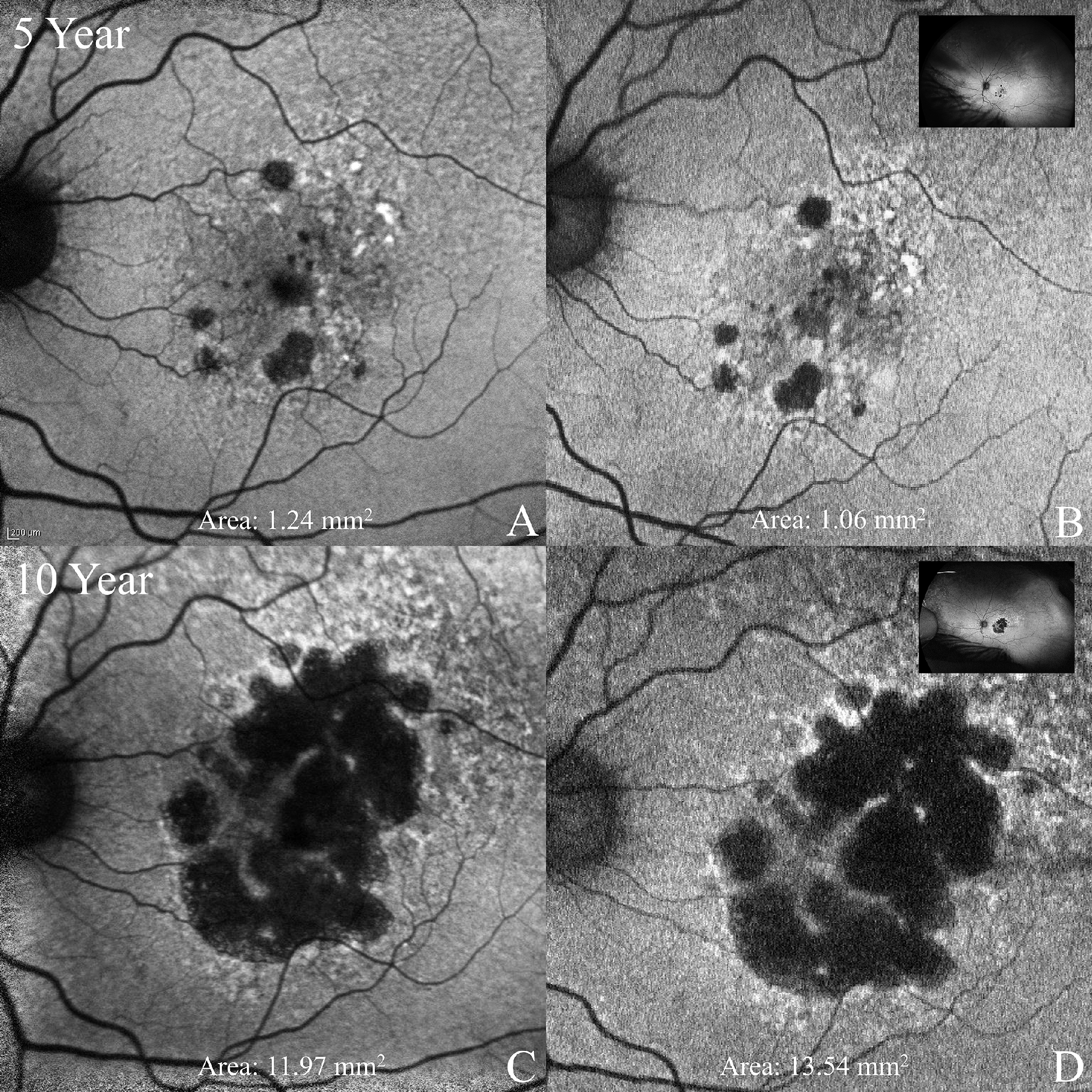 Most features associated with geographic atrophy were comparable between the two tested modalities, except for reticular pseudodrusen, which was less visible on Optos images. These images from the TVST paper show geographic atrophy progression between five-year (A, B) and 10-year (C, D) time points observed on standard field (A, C) and ultra-widefield (B, D) devices.