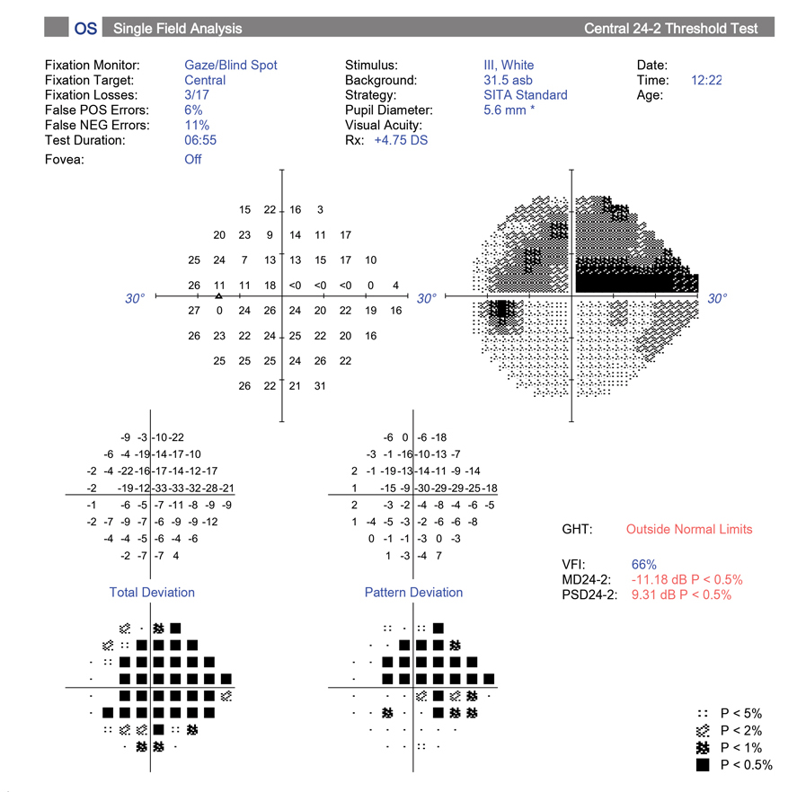 The poor performance of the OHTS-EGPS prediction model in this study may be partially explained by its reliance on a VF-based conversion event definition.