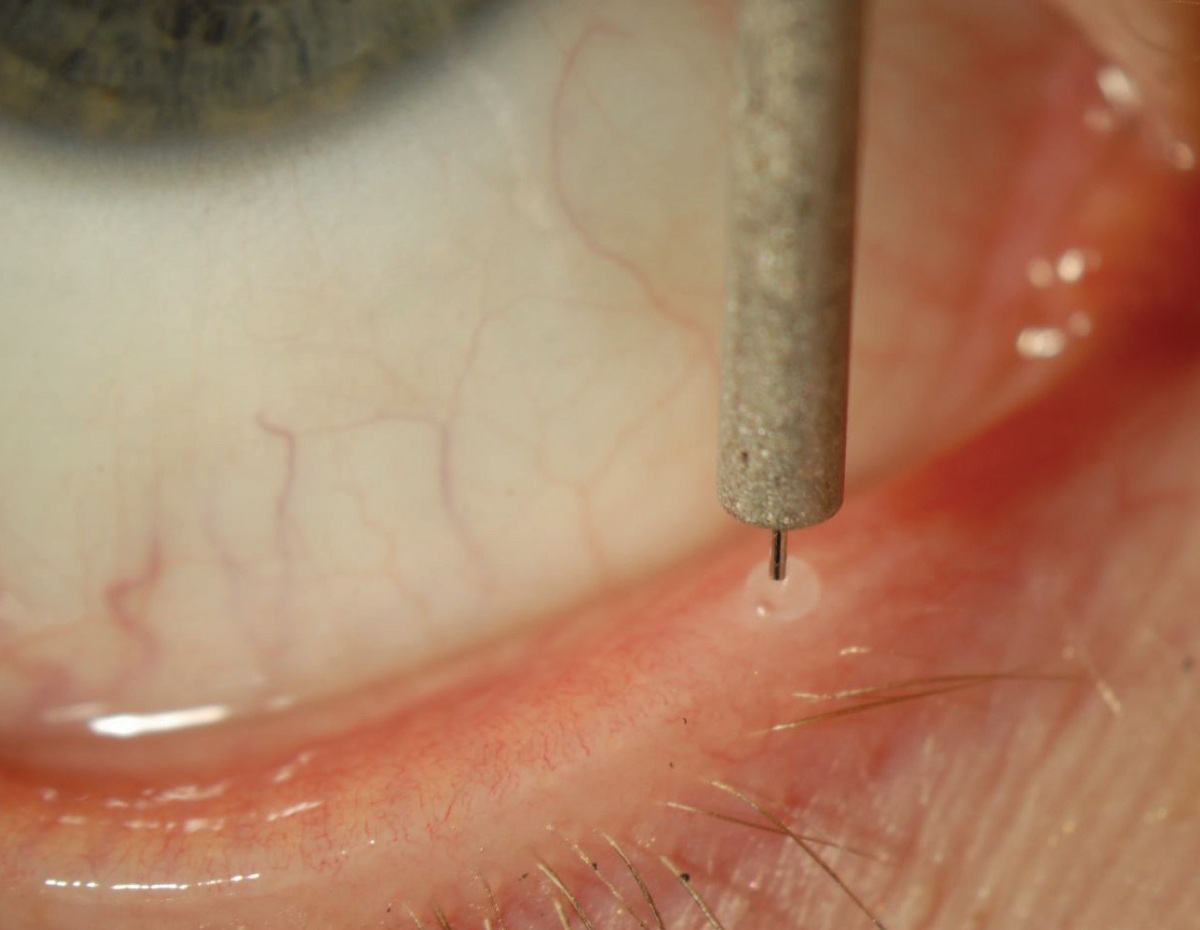 Punctal plugs and intracanalicular devices can become colonized with bacteria composed of oropharyngeal flora, skin flora and other rare but potentially significant pathogens.