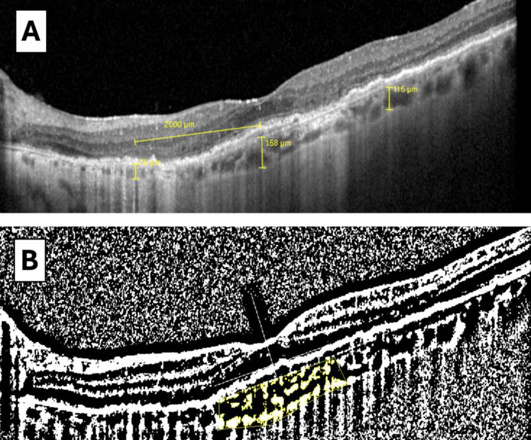 Choroidal thickness and choroidal vascularity index (CVI) measurements on OCT may help further stratify the risk of progression in AMD, a new study finds. Its results showed that more rapid changes in choroidal thickness and CVI over time may indicate a higher risk for geographic atrophy development. These images from the study show (A) choroidal thickness measurement at three different points of the macular area) and (B) calculation of subfoveal CVI from a binarized image, with the dark pixels representing the vessels’ luminal area and the white pixels the stromal area. Total luminal area divided by total choroidal area represents the CVI, a measure of the structure’s vascular capacity. 