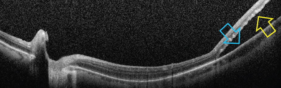 One theory for possible etiology of RRD following pilocarpine is due to ciliary muscle contraction and rotation, which may exert traction and stretching on the peripheral retina and result in in retinal breaks near the ora serrata.