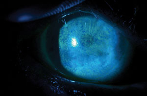 In patients with Sjögren’s syndrome, increased activity of matrix metalloproteinases on the ocular surface can lead to damage of the lacrimal ducts and gland and ultimately increase the risk for corneal ulcers.