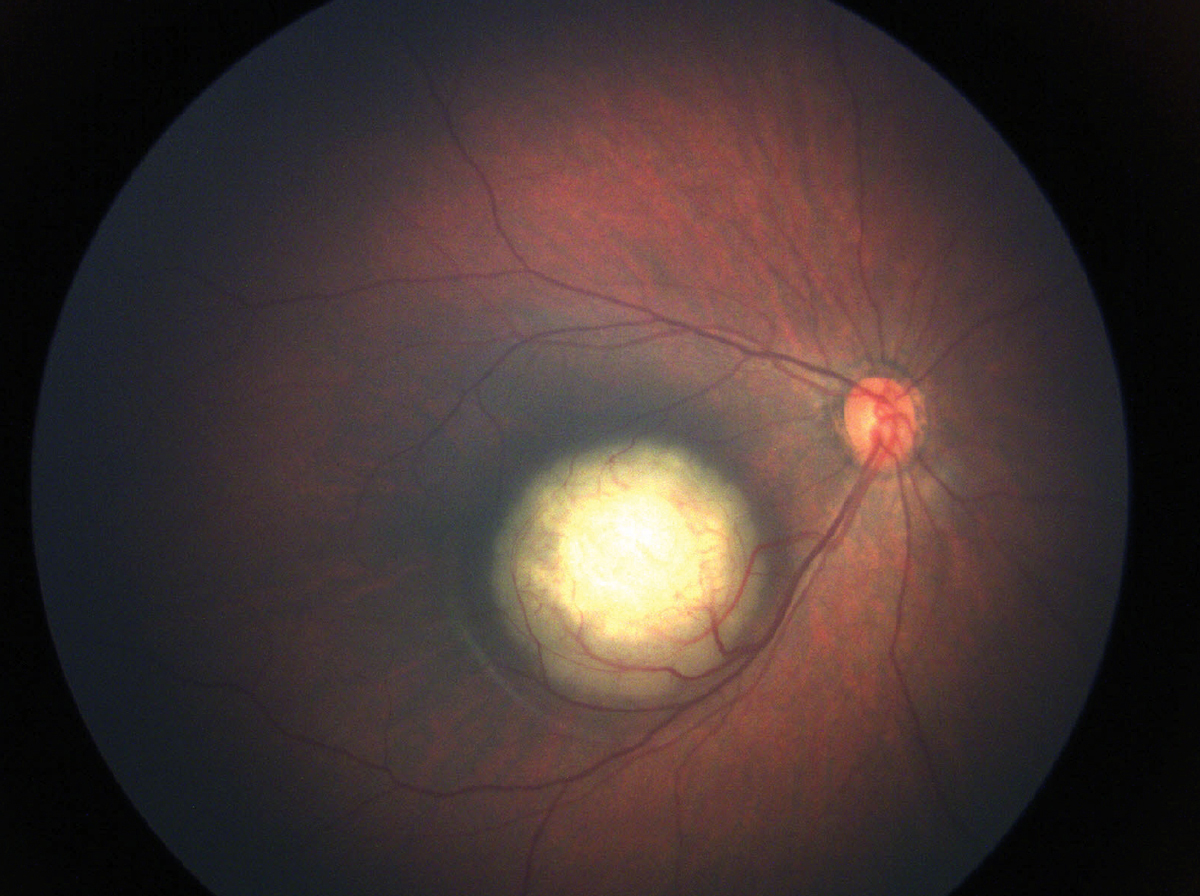 Non-metropolitan residence was significantly associated with more advanced disease at presentation and greater likelihood of enucleation. Non-metropolitan residence was notably associated with an almost ninefold increase in odds of local recurrence after primary globe-sparing therapy.