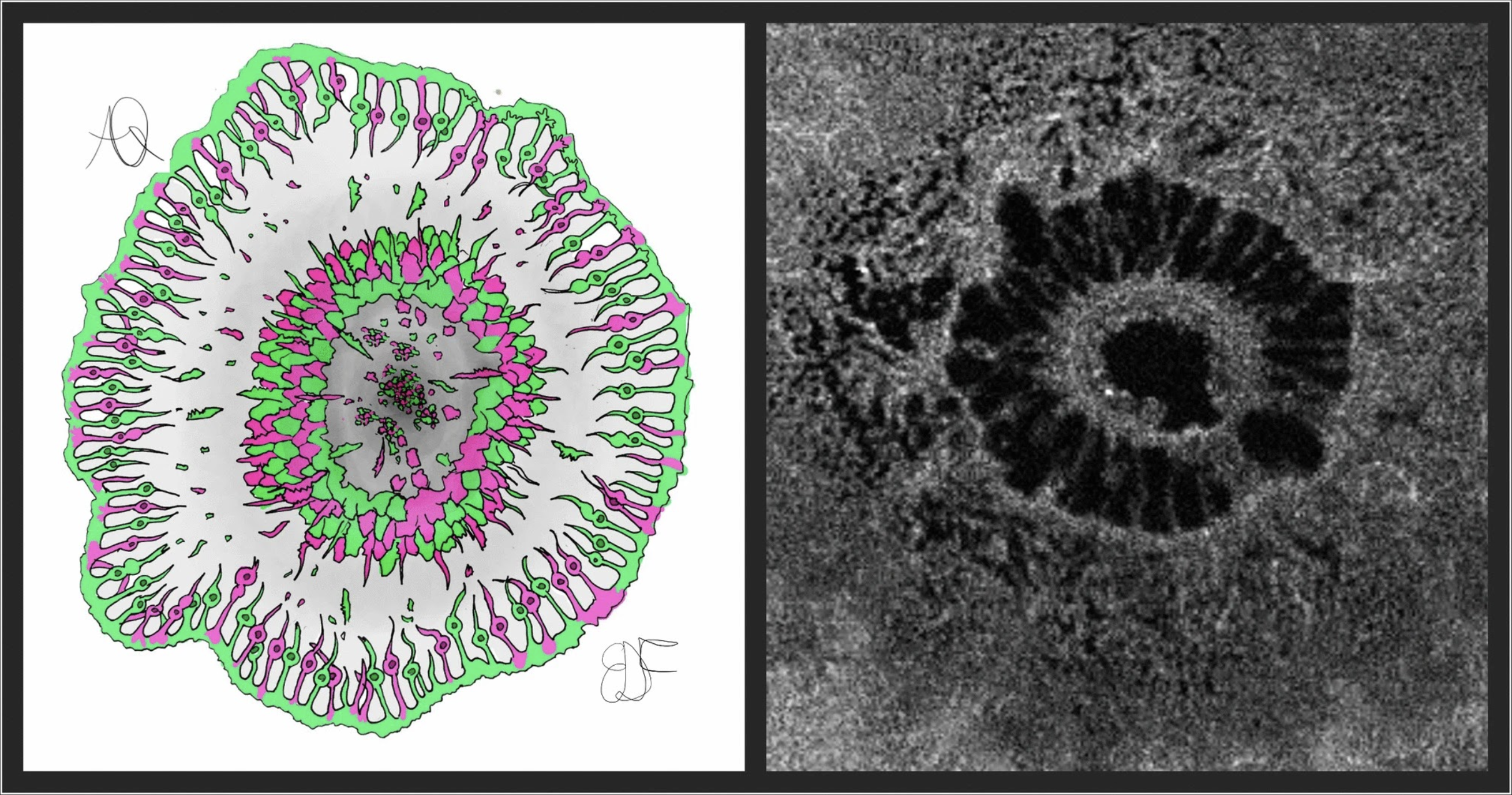 In a new study, photoreceptor integrity correlated to functional and anatomical visual outcomes of full-thickness macular hole. Once validated in further studies, the quantitative metric may help clinicians better predict post-op visual recovery and set realistic expectations for patients. These images from the study, of an illustration (left) and en face OCT scan (right) scan, show densely packed photoreceptors at the border of the hole, with disrupted ones that fall off the border and lie over the RPE as remnants. Considering the oxygen’s role in photoreceptors nutrition through choroid, at the maximum height of neurosensory detachment and by focusing at the end of the external limiting membrane, the hypoxic phenomenon may be exacerbated due to the distance from the first oxygen and nutrients source, the researchers explain in their paper on the work.