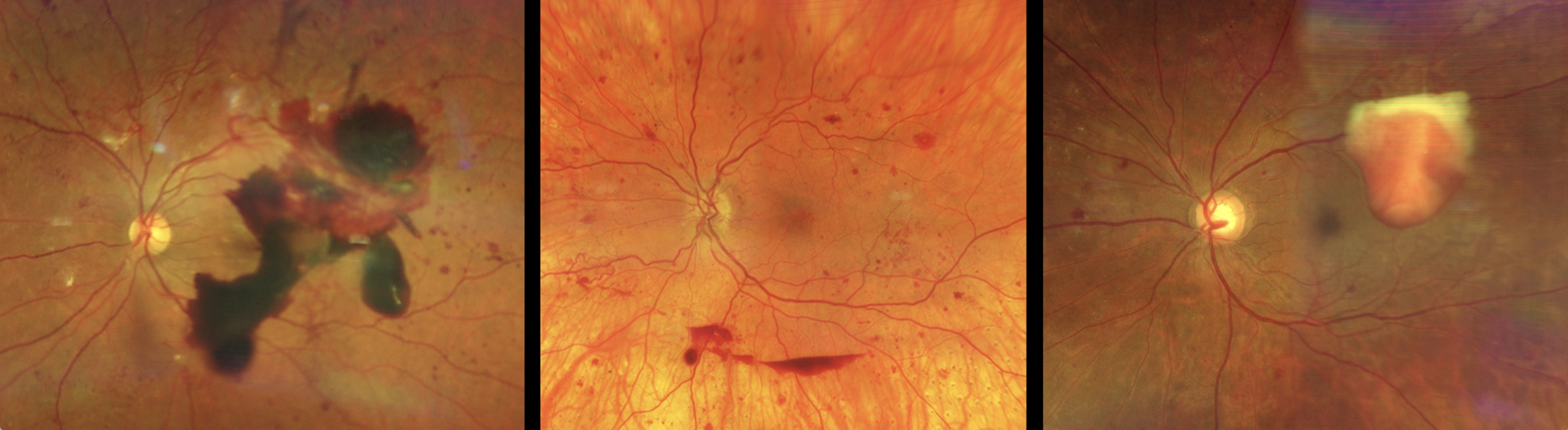 Despite adequate laser treatment, many PDR eyes still experience complications such as persistent neovascularization, recurrent vitreous hemorrhage and tractional retinal detachment.