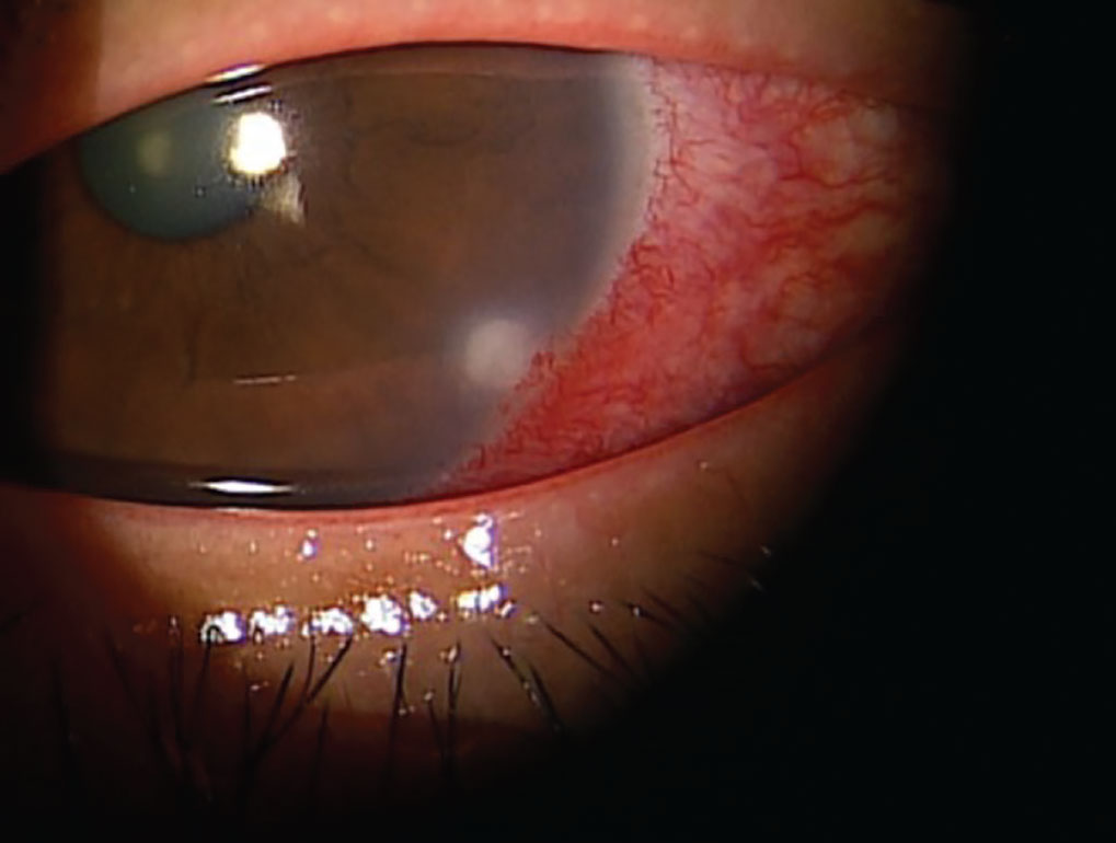 The common drug dupilumab, used to treat atopic dermatitis, chronic sinusitis and eczema, can cause limbal infiltrates.