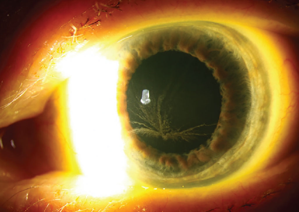 Vortex keratopathy typically follows the natural centripetal migration of the corneal epithelium from limbus to center.