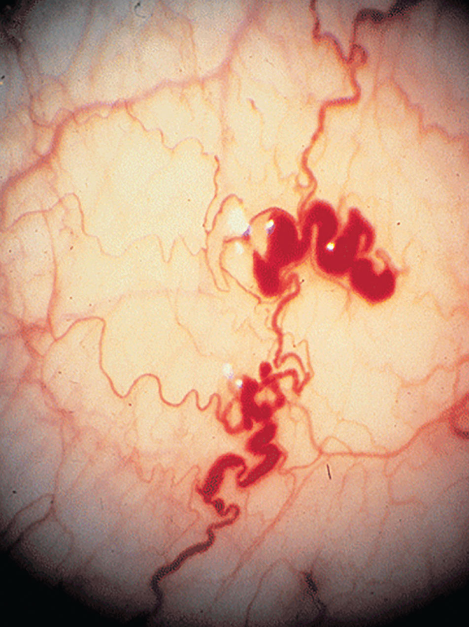 The small vessels of the conjunctiva in Fabry disease often show aneurysmal dilations, tortuosity and kinking.