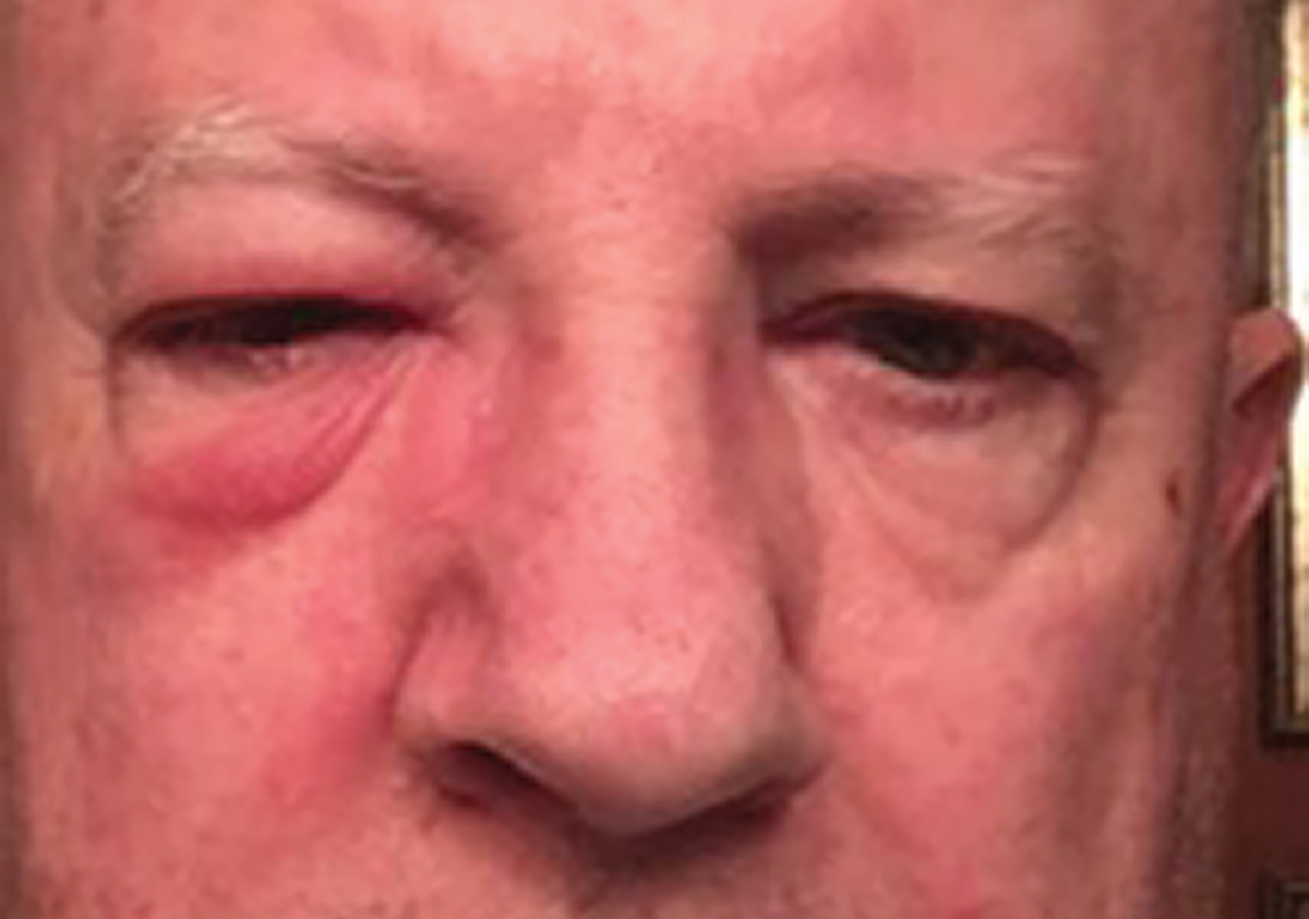 Preseptal cellulitis with eyelid erythema and edema in a patient with no ocular complications.