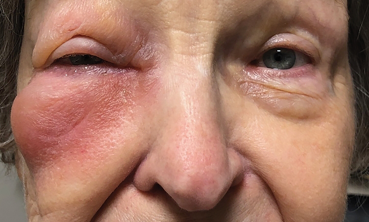 Extensive eyelid edema suggestive of preseptal vs. orbital cellulitis warranting further clinical evaluation. 