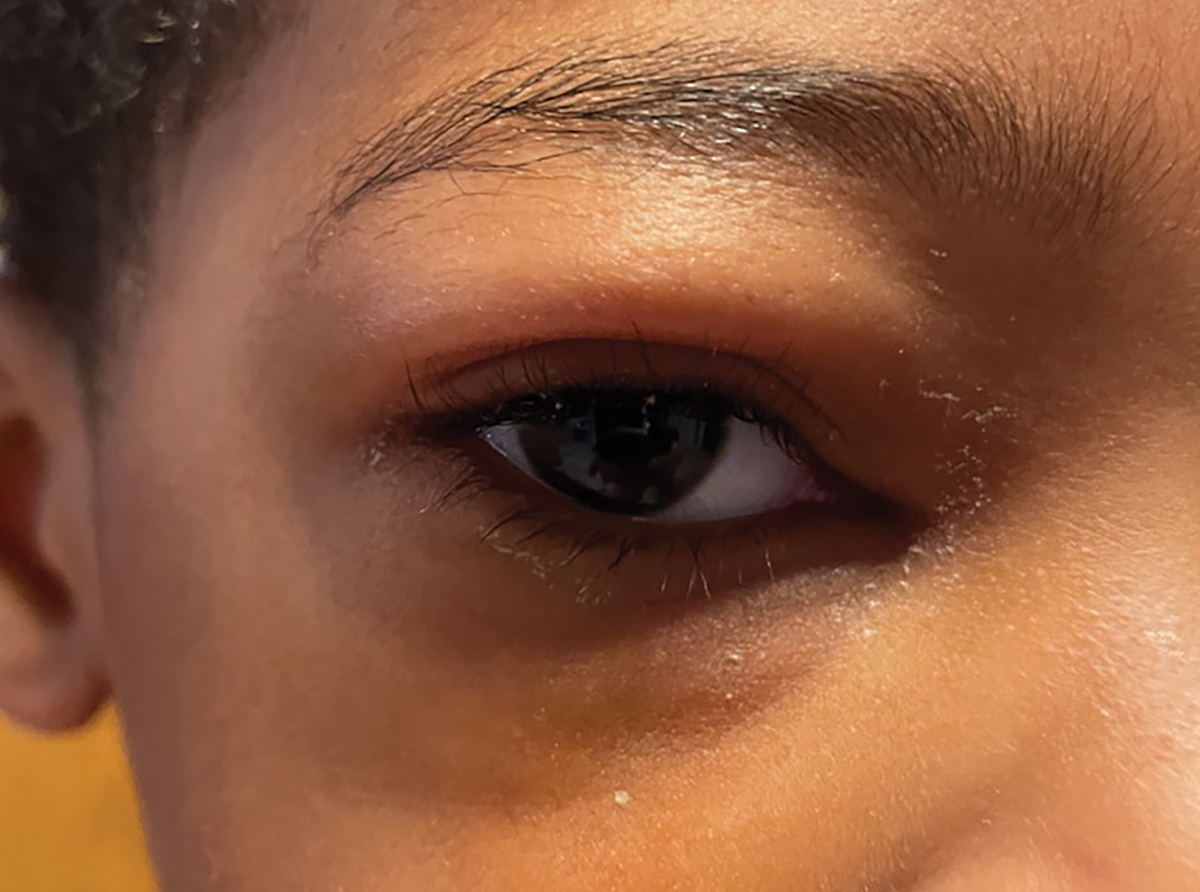 Unilateral edema of upper eyelid and lower eyelid that extends into the orbit, concerning for orbital cellulitis. 