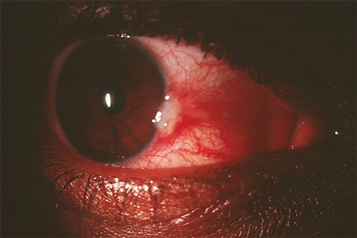 Fig. 1. Pingueculitis can often be mistaken for nodular episcleritis or scleritis.