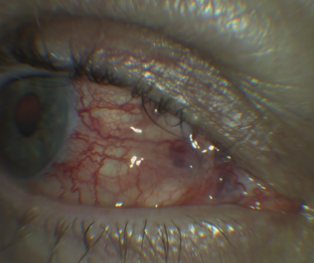 Fig. 2. Idiopathic orbital inflammation, a condition that may be commonly misdiagnosed as scleritis due to the pronounced deep bulbar injection.