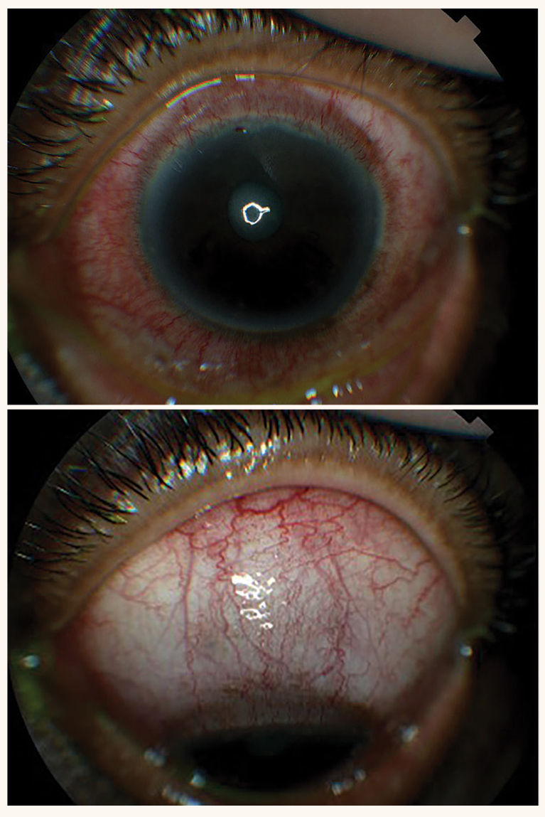 Fig. 3. These photos show an example of diffuse non-necrotizing anterior scleritis.