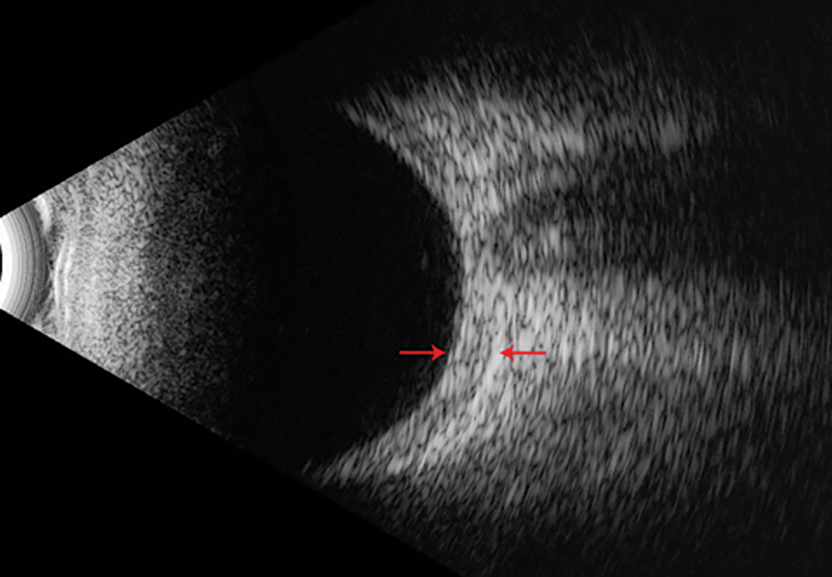 Fig. 4. An example of a B-scan with a thickened posterior sclera without a hallmark “T-sign” as noted by the red arrows.