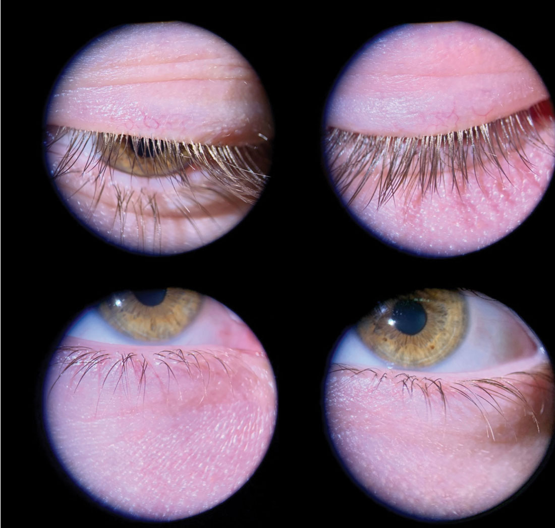 Fig. 1. Even mild Demodex blepharitis should be caught and treated early to prevent progression. This young male patient has collarettes at the lash bases and mild flaking.