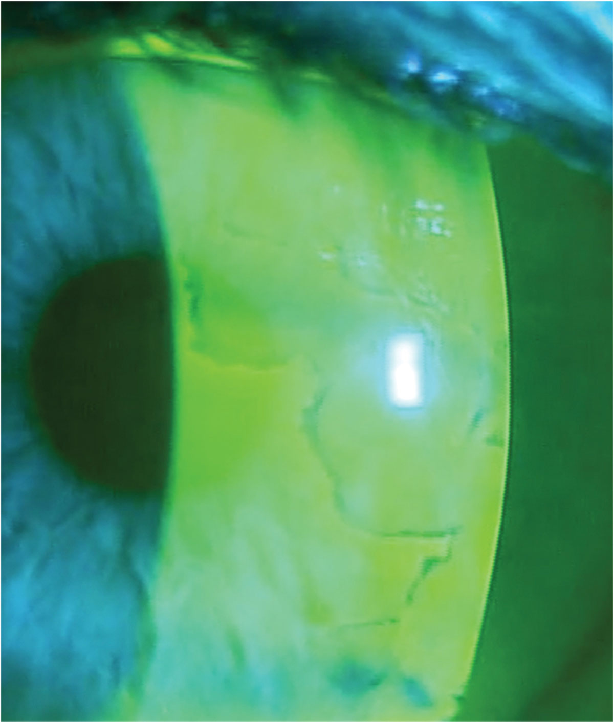 Fig. 4. Using sodium fluorescein dye at the slit lamp helps delineate dots and fingerprint patterns associated with EBMD.