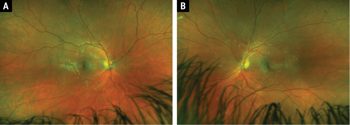 Fig. 1. Widefield Optos fundus photos of right (A) and left (B) eyes.