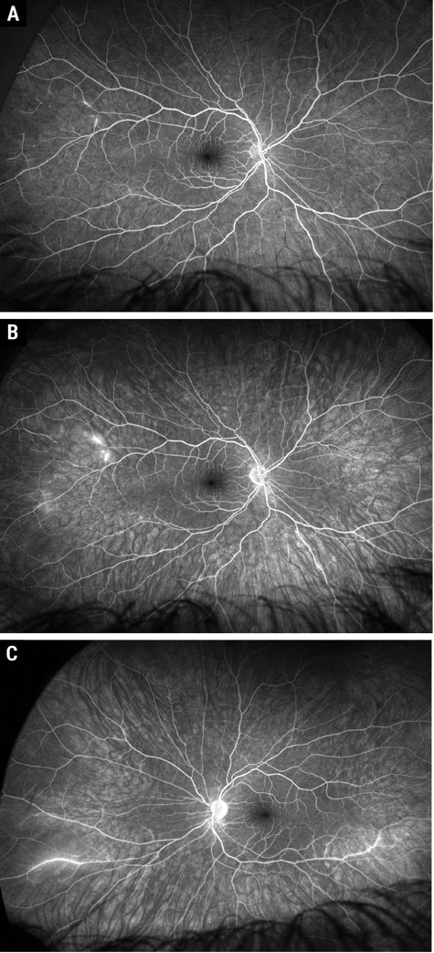 Fig. 2. Widefield Optos fluorescein angiogram early and late phase of the right eye (A and B) and late phase of the left eye (C).